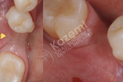 dental implant with bone graft kazemi oral surgery.001