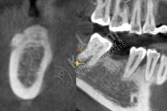 dental implant with bone graft kazemi oral surgery.002