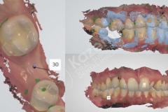 dental implant with bone graft kazemi oral surgery.003