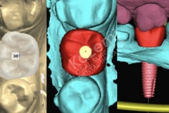 dental implant with bone graft kazemi oral surgery.004