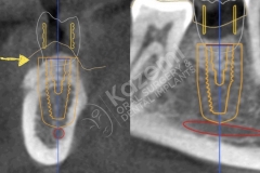 dental implant with bone graft kazemi oral surgery.005