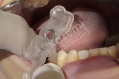 dental implant with bone graft kazemi oral surgery.006