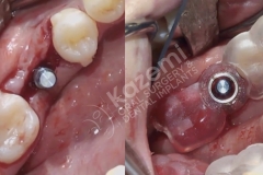 dental implant with bone graft kazemi oral surgery.007