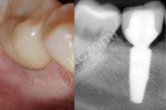 dental implant with bone graft kazemi oral surgery.010