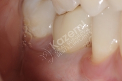 dental implant with bone graft kazemi oral surgery.011