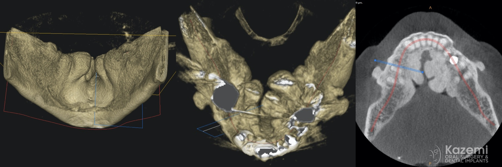 removal-of-very-large-bilateral-mandibular-tori-torus-piezo-PRF-membrane-kazemi-oral-surgery-2