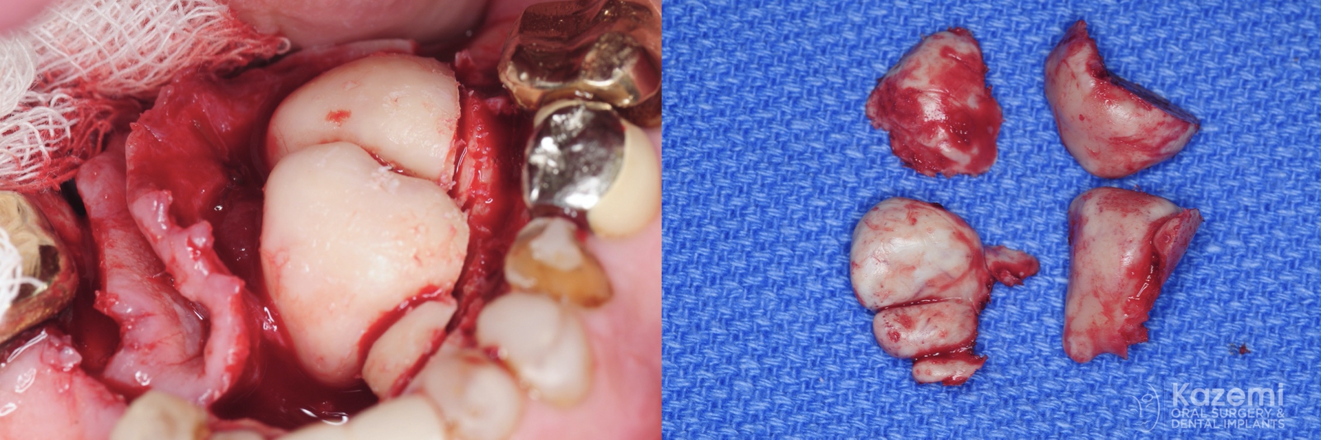 removal-of-very-large-bilateral-mandibular-tori-torus-piezo-PRF-membrane-kazemi-oral-surgery-3