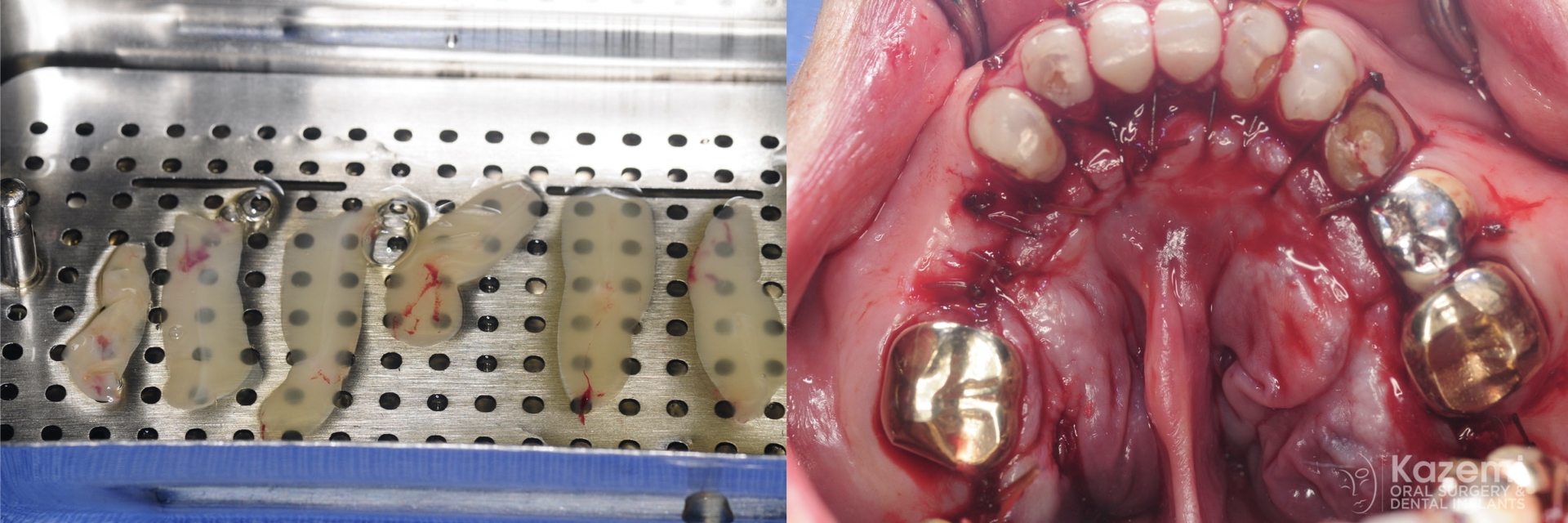 removal-of-very-large-bilateral-mandibular-tori-torus-piezo-PRF-membrane-kazemi-oral-surgery-5