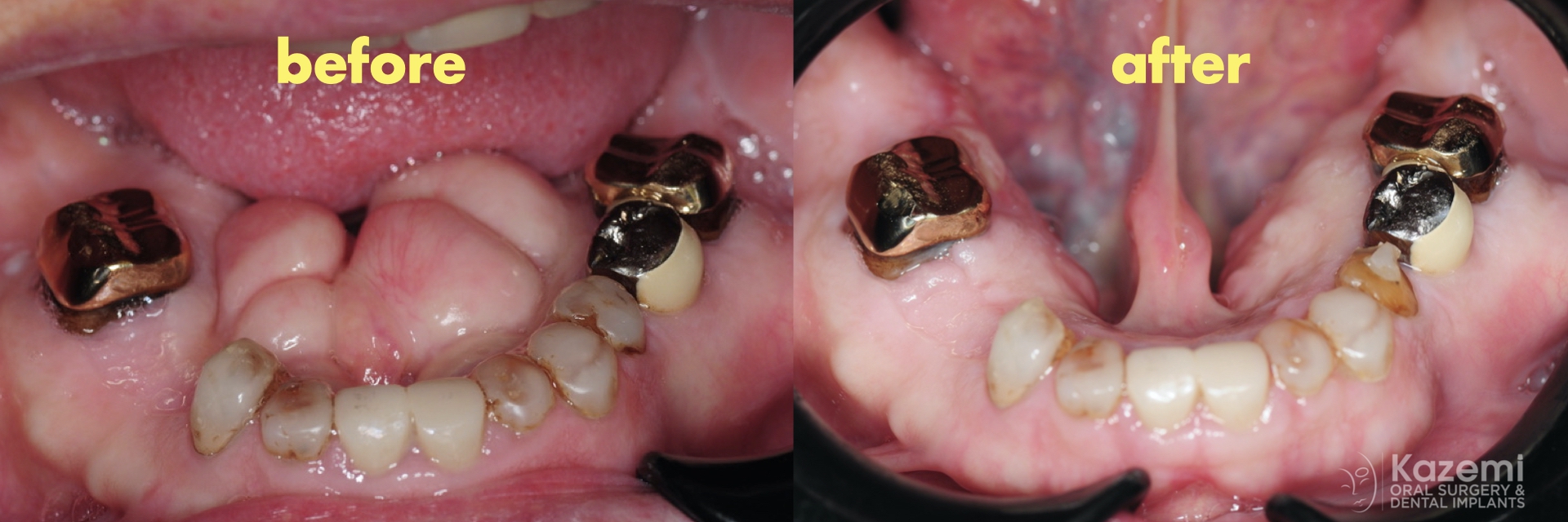 removal-of-very-large-bilateral-mandibular-tori-torus-piezo-PRF-membrane-kazemi-oral-surgery-6