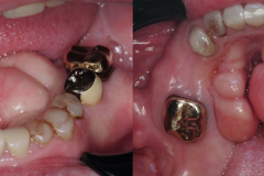 removal-of-very-large-bilateral-mandibular-tori-torus-piezo-PRF-membrane-kazemi-oral-surgery-1