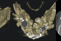 removal-of-very-large-bilateral-mandibular-tori-torus-piezo-PRF-membrane-kazemi-oral-surgery-2