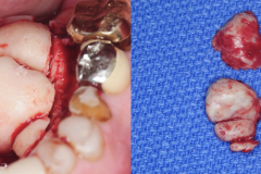 removal-of-very-large-bilateral-mandibular-tori-torus-piezo-PRF-membrane-kazemi-oral-surgery-3