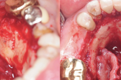 removal-of-very-large-bilateral-mandibular-tori-torus-piezo-PRF-membrane-kazemi-oral-surgery-4