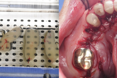 removal-of-very-large-bilateral-mandibular-tori-torus-piezo-PRF-membrane-kazemi-oral-surgery-5