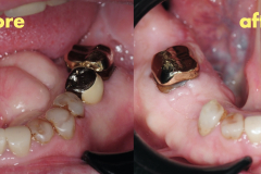 removal-of-very-large-bilateral-mandibular-tori-torus-piezo-PRF-membrane-kazemi-oral-surgery-6