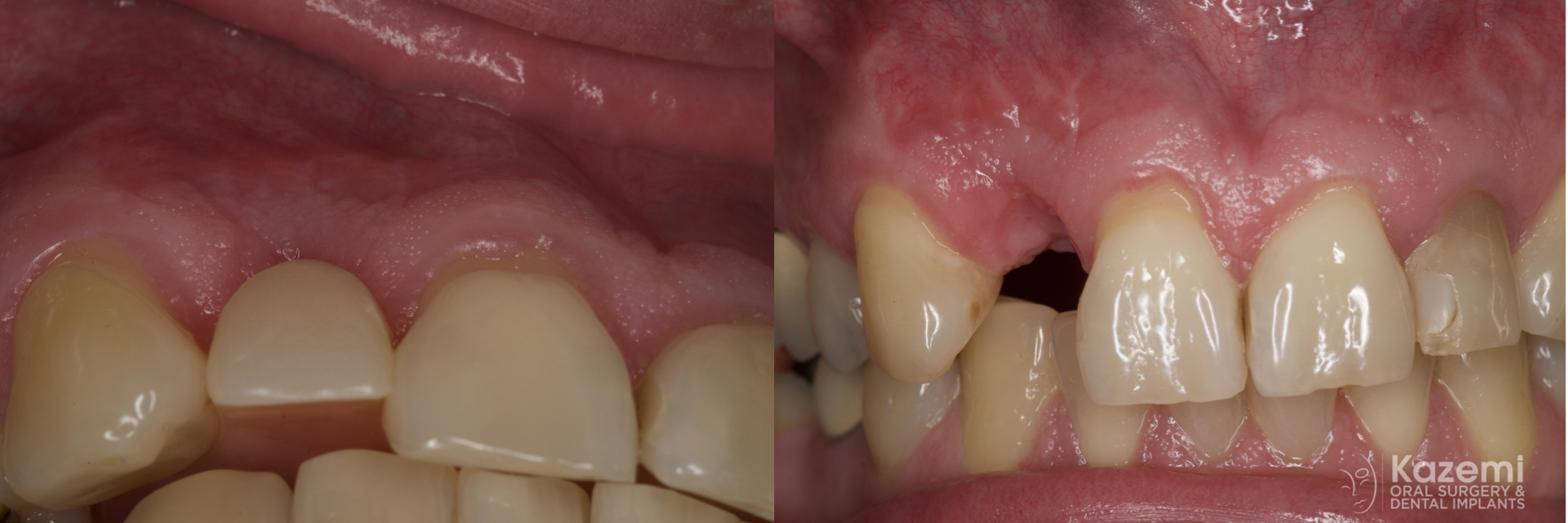 2.-missing-lateral-incisor-gum-recession-kazemi-oral-surgery
