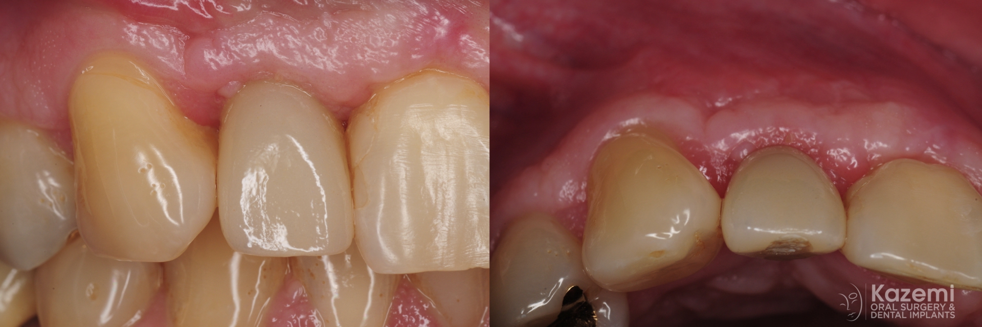 4.-dental-implant-crown-gum-graft-for-recession-kazemi-oral-surgery
