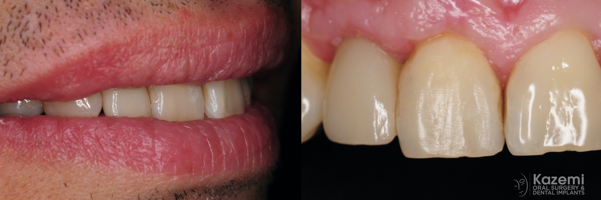 5.-smile-implant-crown-kazemi-oral-surgery