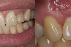 1.-missing-lateral-incisor-gum-recession-kazemi-oral-surgery