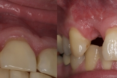 2.-missing-lateral-incisor-gum-recession-kazemi-oral-surgery