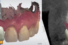 2.5-digital-dental-implant-lateral-incisor-kazemi-oral-surgery