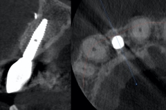 3.-dental-implant-lateral-incisor-guided-kazemi-oral-surgery