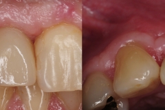 4.-dental-implant-crown-gum-graft-for-recession-kazemi-oral-surgery
