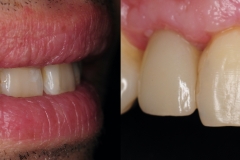 5.-smile-implant-crown-kazemi-oral-surgery