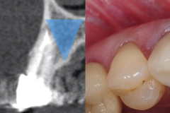 1.-dental-implant-canine-partial-extraction-therapy-socket-shield-kazemi-oral-surgery