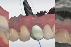 2.-dental-implant-canine-partial-extraction-therapy-socket-digital-work-up-shield-kazemi-oral-surgery