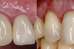 3.-dental-implant-canine-partial-extraction-therapy-socket-shield-kazemi-oral-surgery