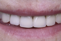 4.-dental-implant-canine-partial-extraction-therapy-socket-shield-kazemi-oral-surgery