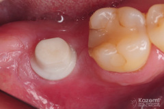 removal-of-ceramic-zirconia-dental-implant-kazemi-oral-surgery01