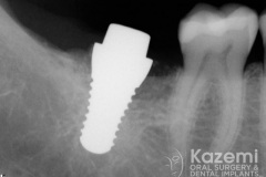 removal-of-ceramic-zirconia-dental-implant-kazemi-oral-surgery02