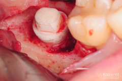 removal-of-ceramic-zirconia-dental-implant-kazemi-oral-surgery03