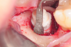 removal-of-ceramic-zirconia-dental-implant-kazemi-oral-surgery04