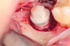 removal-of-ceramic-zirconia-dental-implant-kazemi-oral-surgery05