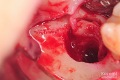 removal-of-ceramic-zirconia-dental-implant-kazemi-oral-surgery06