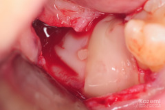 removal-of-ceramic-zirconia-dental-implant-kazemi-oral-surgery07