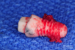 removal-of-ceramic-zirconia-dental-implant-kazemi-oral-surgery08