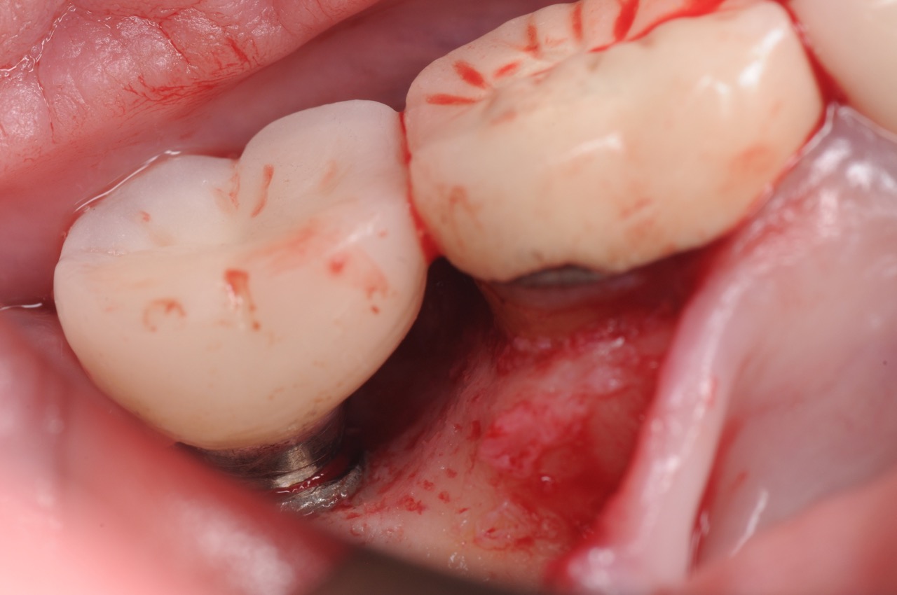 5. Peri-implantitis cement pain bleeding dental implant kazemi oral surgery
