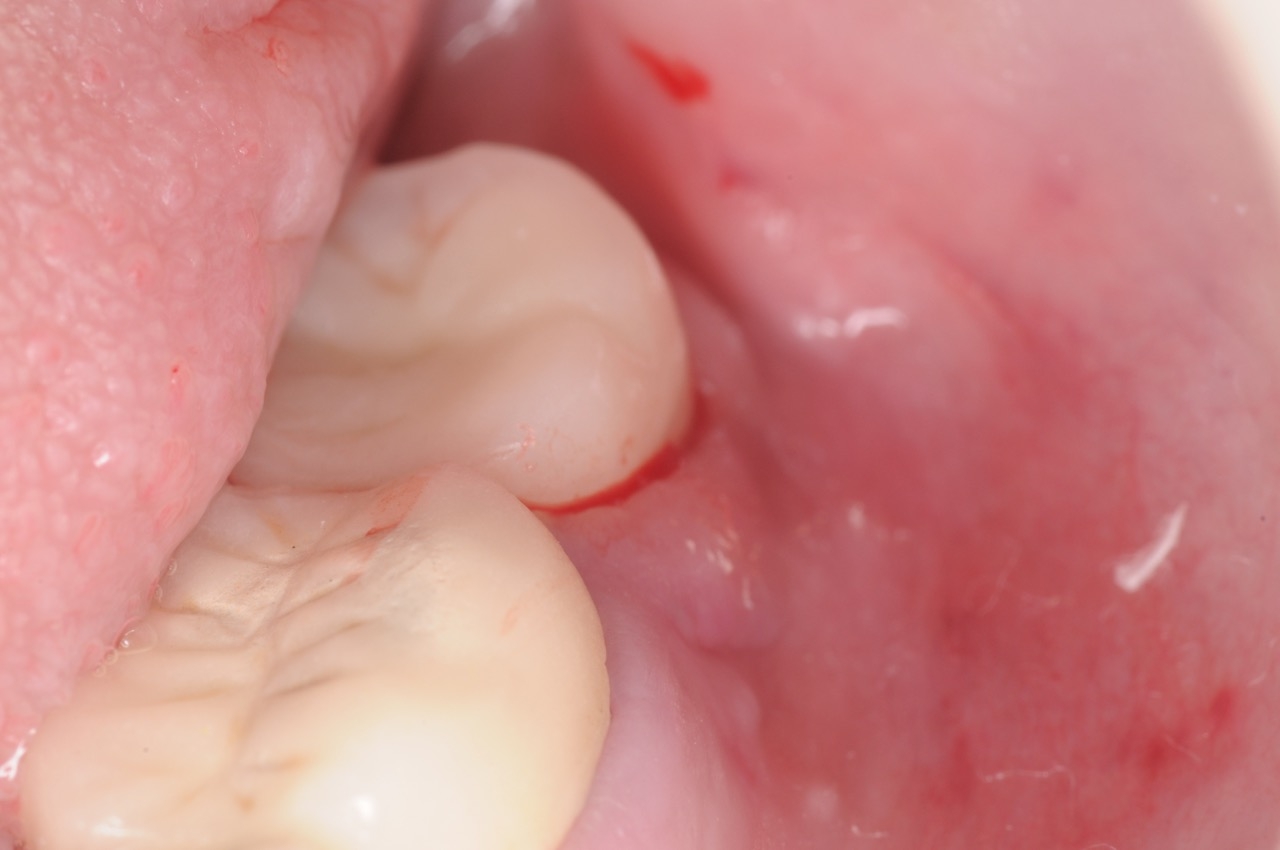 1. Peri-implantitis cement pain bleeding dental implant kazemi oral surgery