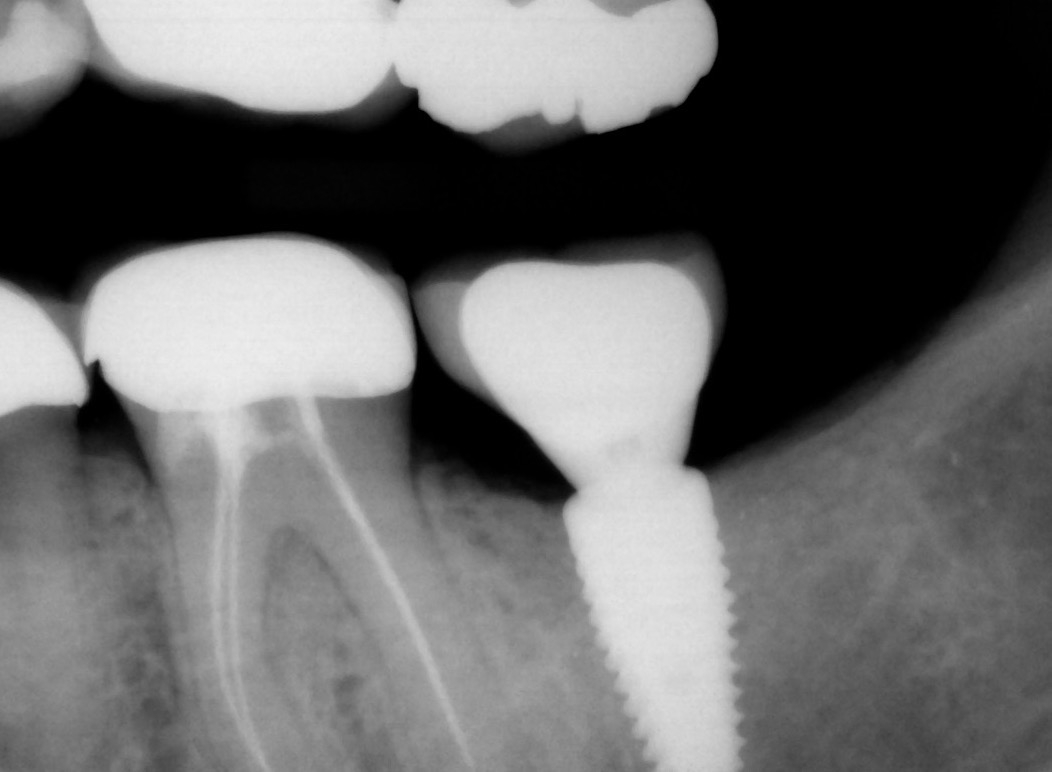 2. Peri-implantitis cement pain bleeding dental implant kazemi oral surgery