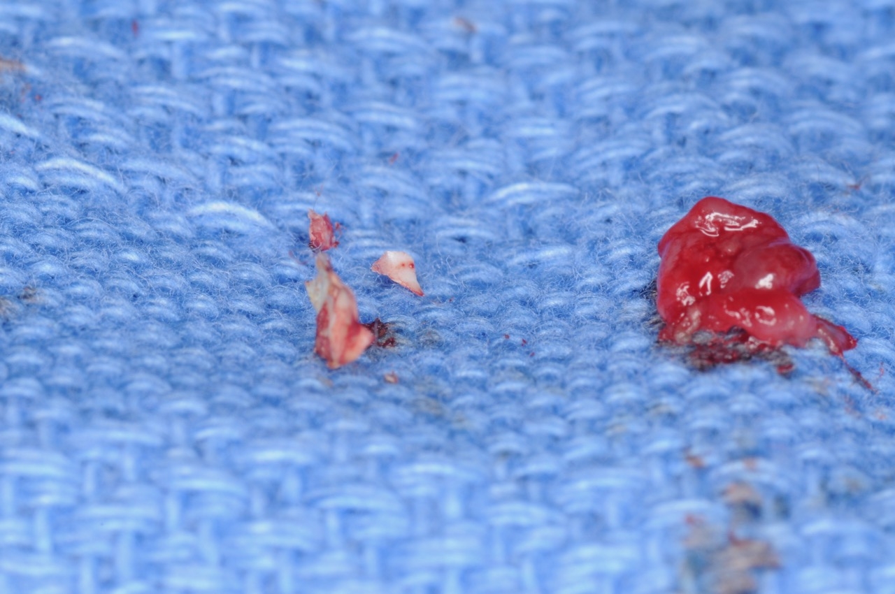 6. Peri-implantitis cement pain bleeding dental implant kazemi oral surgery