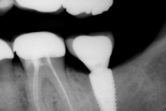 2. Peri-implantitis cement pain bleeding dental implant kazemi oral surgery