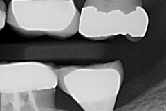 3. Peri-implantitis cement pain bleeding dental implant kazemi oral surgery