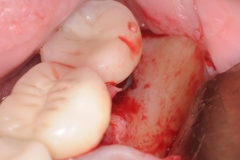 4 Peri-implantitis cement pain bleeding dental implant kazemi oral surgery