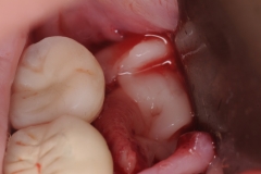 7. Peri-implantitis cement pain bleeding dental implant kazemi oral surgery