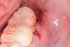 8. Peri-implantitis cement pain bleeding dental implant kazemi oral surgery
