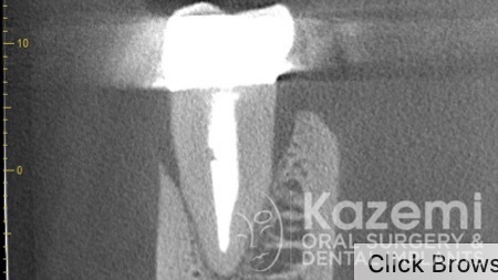 dental-implant-molar-tooth-extraction-bone-loss-digital-dentistry-kazemi-oral-surgery-giannini-gray1